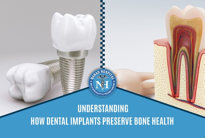 Understanding How Dental Implants Preserve Bone Health